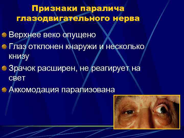 Признаки паралича глазодвигательного нерва Верхнее веко опущено Глаз отклонен кнаружи и несколько книзу Зрачок