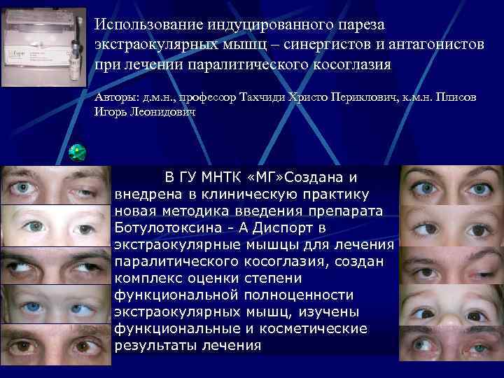 Использование индуцированного пареза экстраокулярных мышц – синергистов и антагонистов при лечении паралитического косоглазия Авторы: