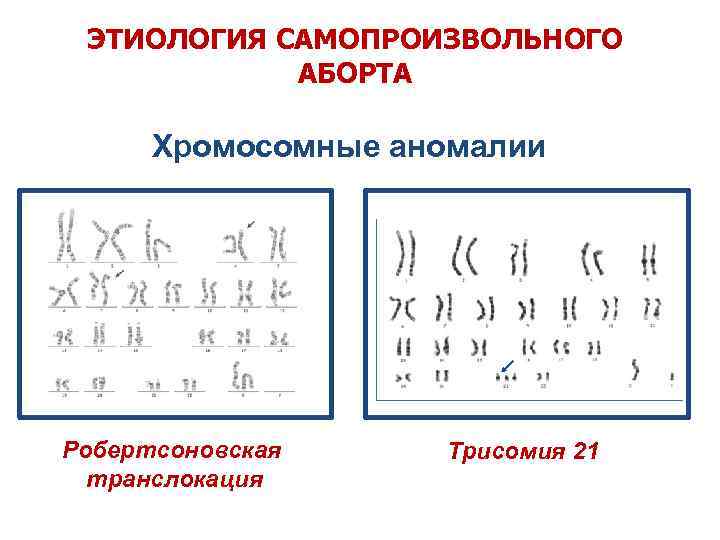 ЭТИОЛОГИЯ САМОПРОИЗВОЛЬНОГО АБОРТА Хромосомные аномалии Робертсоновская транслокация Трисомия 21 