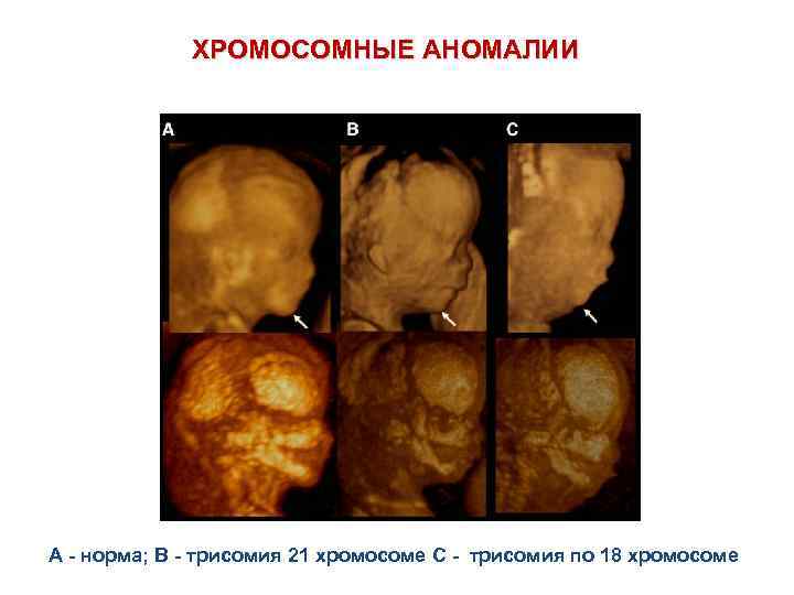 ХРОМОСОМНЫЕ АНОМАЛИИ A - норма; B - трисомия 21 хромосоме C - трисомия по
