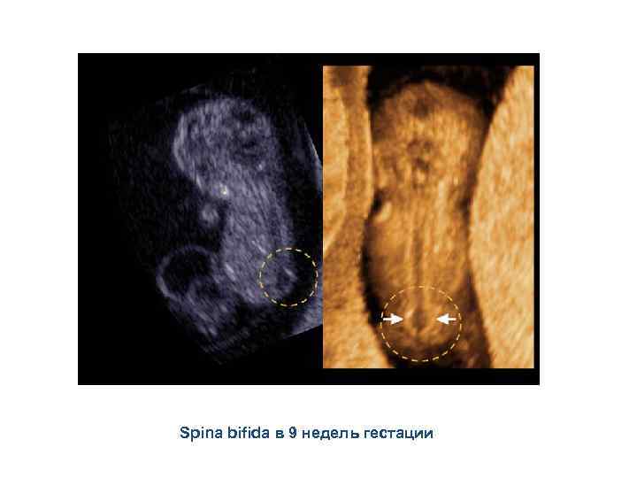 Spina bifida в 9 недель гестации 