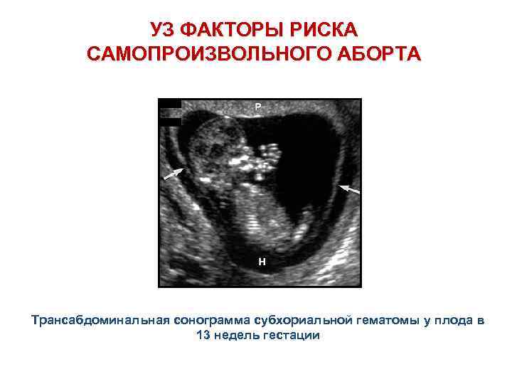 УЗ ФАКТОРЫ РИСКА САМОПРОИЗВОЛЬНОГО АБОРТА Трансабдоминальная сонограмма субхориальной гематомы у плода в 13 недель