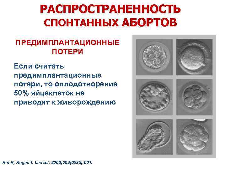 РАСПРОСТРАНЕННОСТЬ СПОНТАННЫХ АБОРТОВ ПРЕДИМПЛАНТАЦИОННЫЕ ПОТЕРИ Если считать предимплантационные потери, то оплодотворение 50% яйцеклеток не