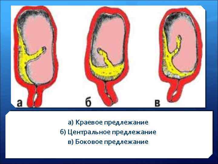 а) Краевое предлежание б) Центральное предлежание в) Боковое предлежание 