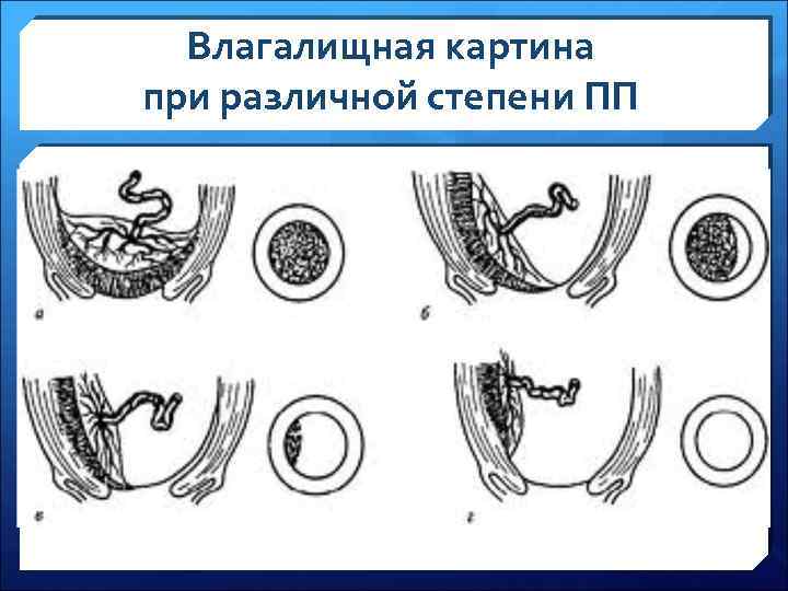 Влагалищная картина при различной степени ПП 