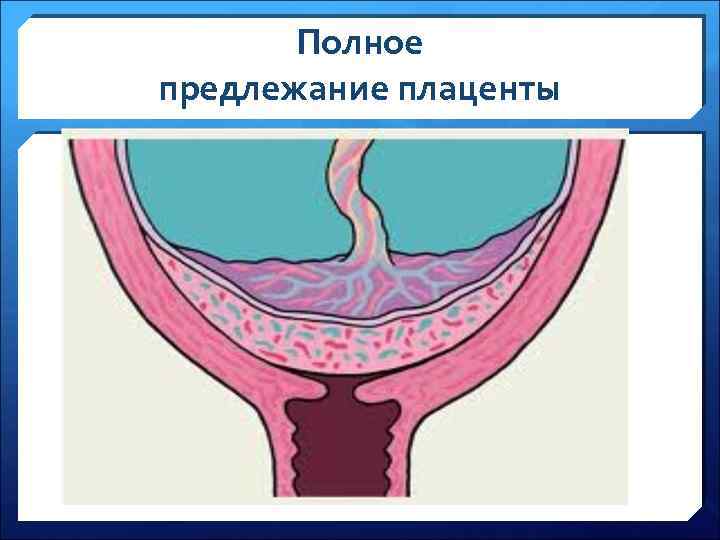 Полное предлежание плаценты 