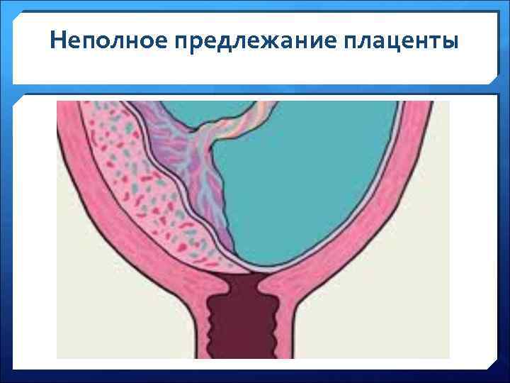 Неполное предлежание плаценты 