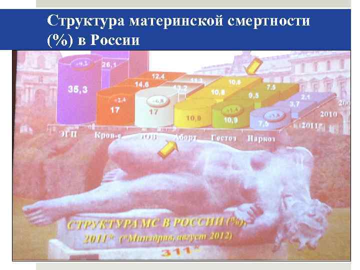 Структура материнской смертности (%) в России 