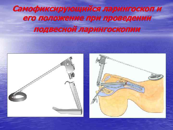 Самофиксирующийся ларингоскоп и его положение при проведении подвесной ларингоскопии 
