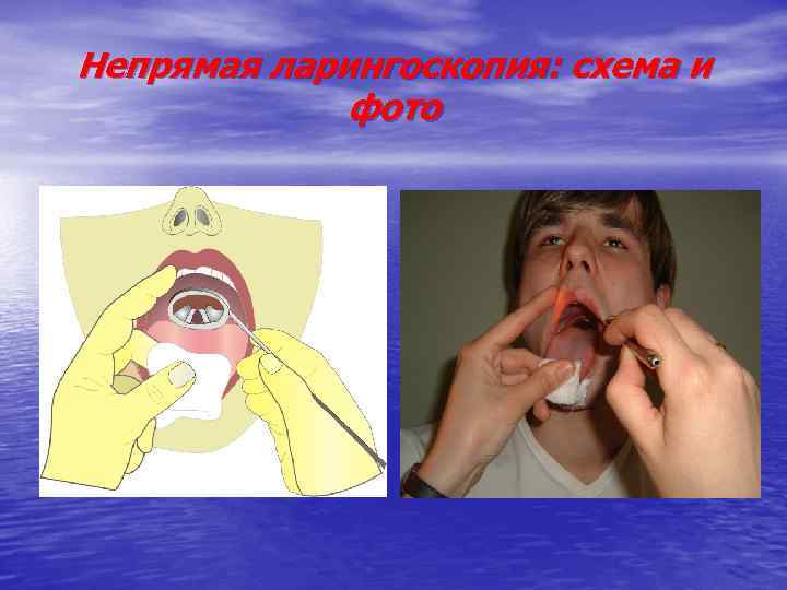 Непрямая ларингоскопия: схема и фото 