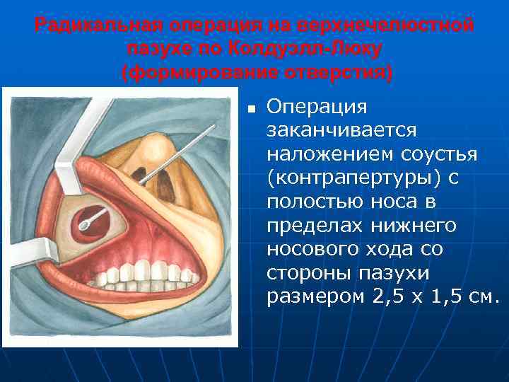 Радикальная операция на верхнечелюстной пазухе по Колдуэлл-Люку (формирование отверстия) n Операция заканчивается наложением соустья