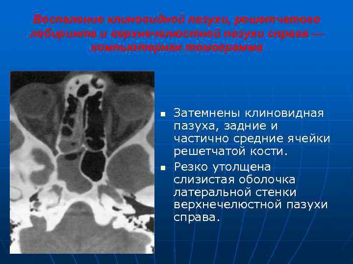 Воспаление клиновидной пазухи, решетчатого лабиринта и верхнечелюстной пазухи справа — компьютерная томограмма n n