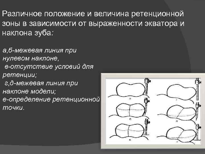 Различное положение и величина ретенционной зоны в зависимости от выраженности экватора и наклона зуба: