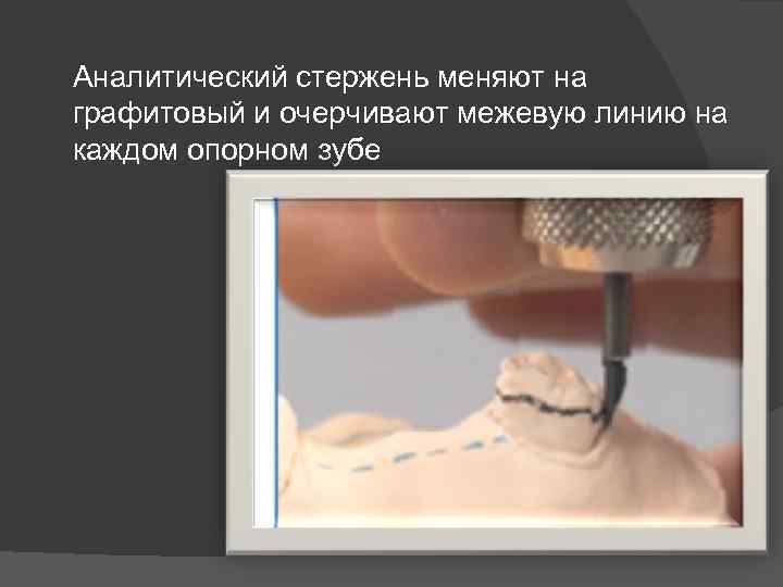 Аналитический стержень меняют на графитовый и очерчивают межевую линию на каждом опорном зубе 