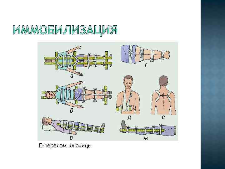 Е-перелом ключицы 