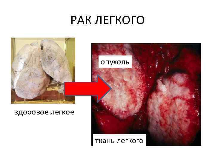 РАК ЛЕГКОГО опухоль здоровое легкое ткань легкого 