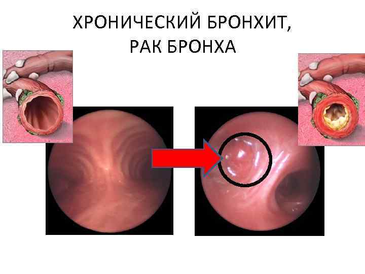 ХРОНИЧЕСКИЙ БРОНХИТ, РАК БРОНХА 