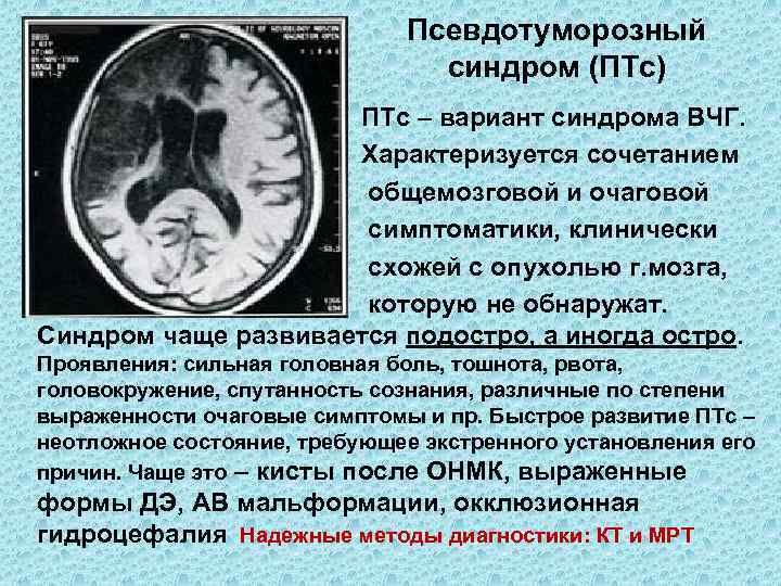 Псевдотуморозный синдром (ПТс) ПТс – вариант синдрома ВЧГ. Характеризуется сочетанием общемозговой и очаговой симптоматики,