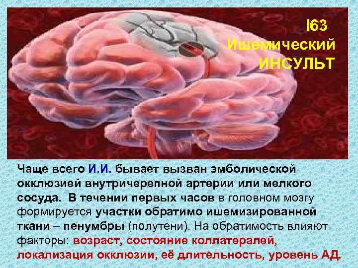  I 63 Ишемический ИНСУЛЬТ Чаще всего И. И. бывает вызван эмболической окклюзией внутричерепной