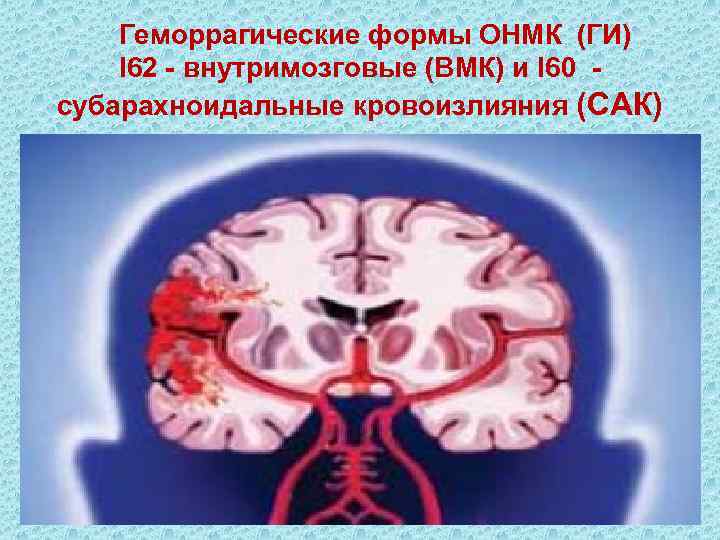  Геморрагические формы ОНМК (ГИ) I 62 - внутримозговые (ВМК) и I 60 субарахноидальные