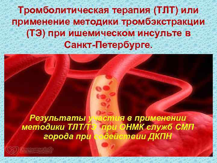 Тромболитическая терапия (ТЛТ) или применение методики тромбэкстракции (ТЭ) при ишемическом инсульте в Санкт-Петербурге. Результаты