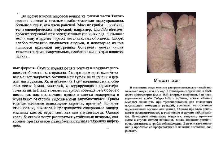 Микозы стоп 