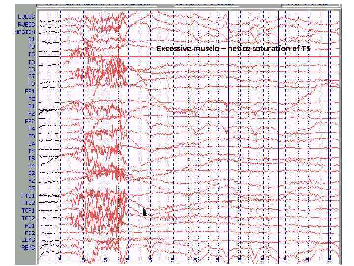 Excessive muscle – notice saturation of T 5 