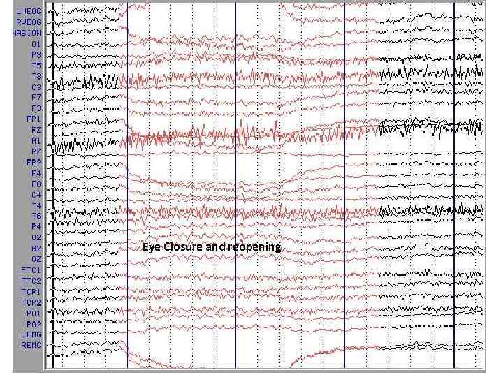 Eye Closure and reopening 