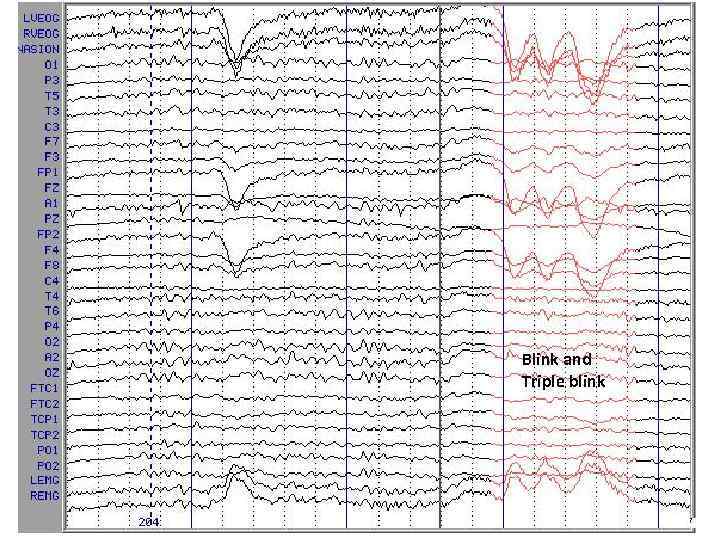 Blink and Triple blink 