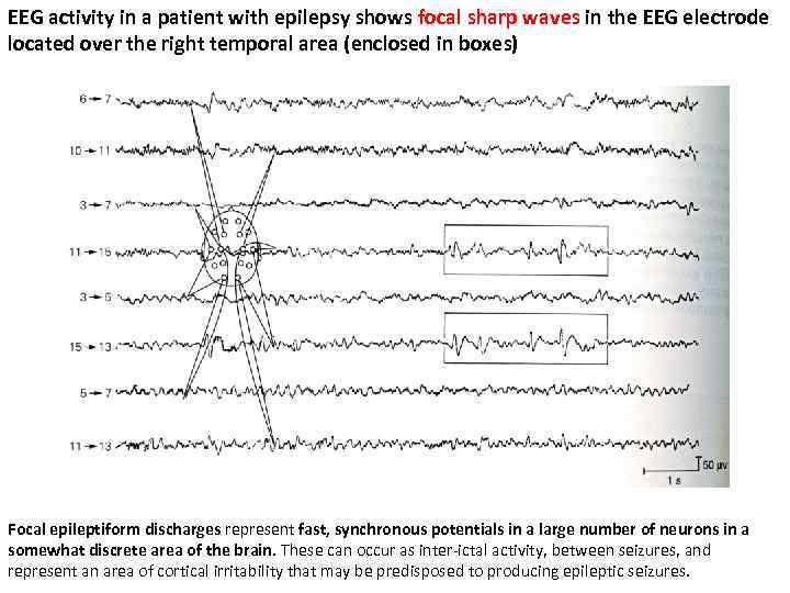 EEG activity in a patient with epilepsy shows focal sharp waves in the EEG