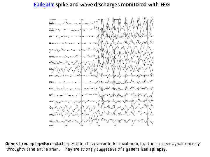 Epileptic spike and wave discharges monitored with EEG Generalized epileptiform discharges often have an