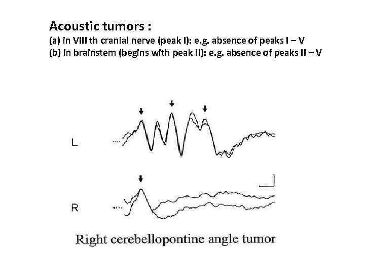 Acoustic tumors : (a) in VIII th cranial nerve (peak I): e. g. absence