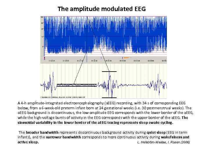 The amplitude modulated EEG A 4 -h amplitude-integrated electroencephalography (a. EEG) recording, with 34