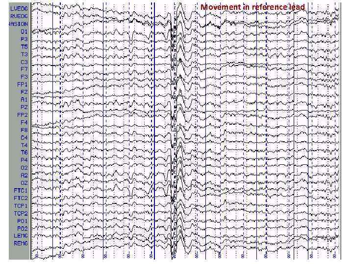 Movement in reference lead 