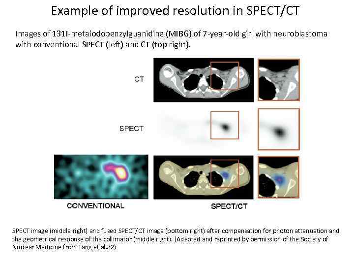 Example of improved resolution in SPECT/CT Images of 131 I-metaiodobenzylguanidine (MIBG) of 7 -year-old