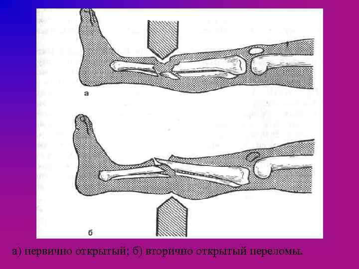 а) первично открытый; б) вторично открытый переломы. 