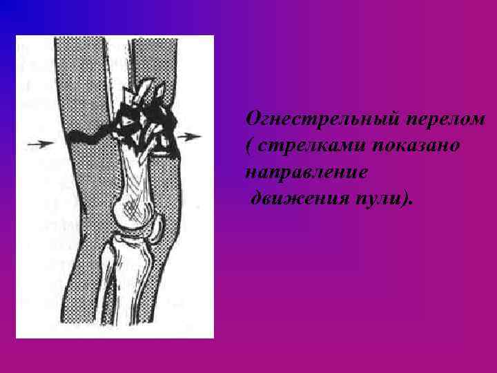 Огнестрельный перелом ( стрелками показано направление движения пули). 