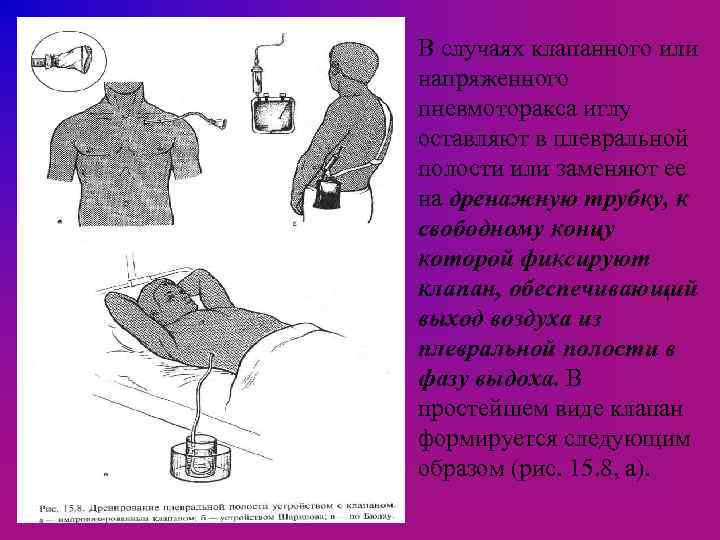 В случаях клапанного или напряженного пневмоторакса иглу оставляют в плевральной полости или заменяют ее