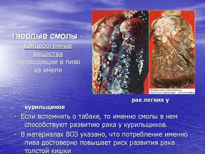 твердые смолы канцерогенные вещества переходящие в пиво из хмеля курильщиков рак легких у -