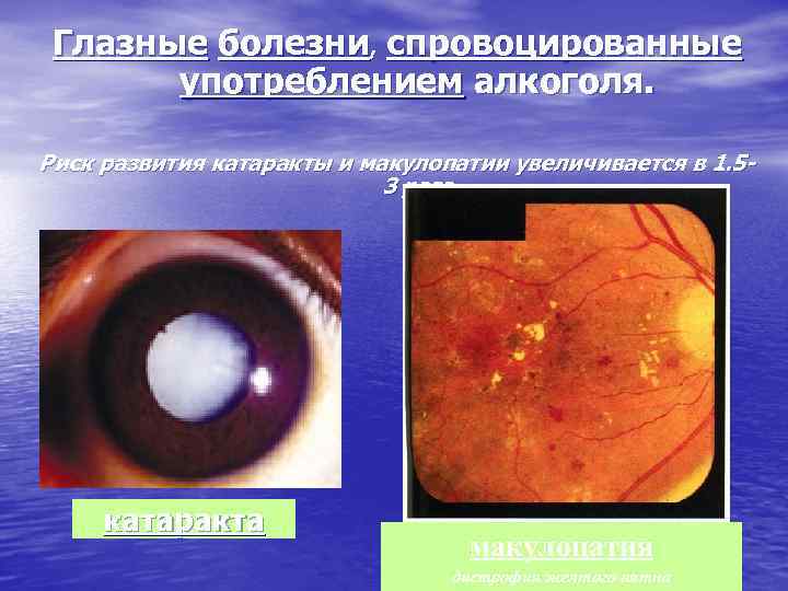 Глазные болезни, спровоцированные употреблением алкоголя. Риск развития катаракты и макулопатии увеличивается в 1. 53