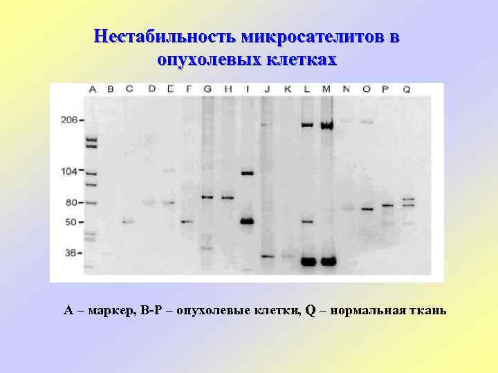 Нестабильность микросателитов в опухолевых клетках А – маркер, В-Р – опухолевые клетки, Q –