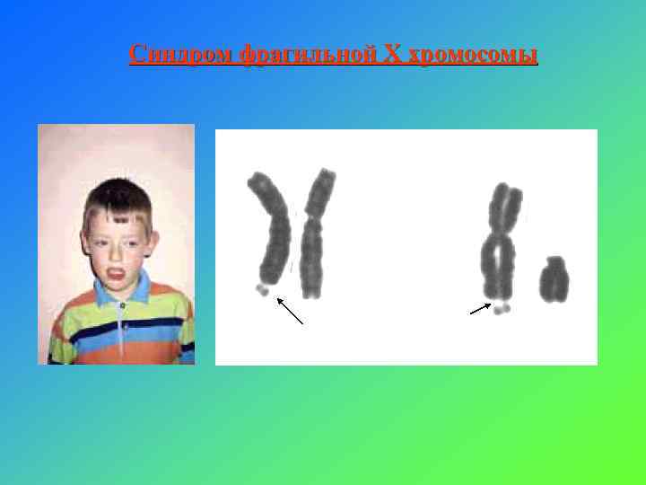 Синдром фрагильной Х хромосомы 