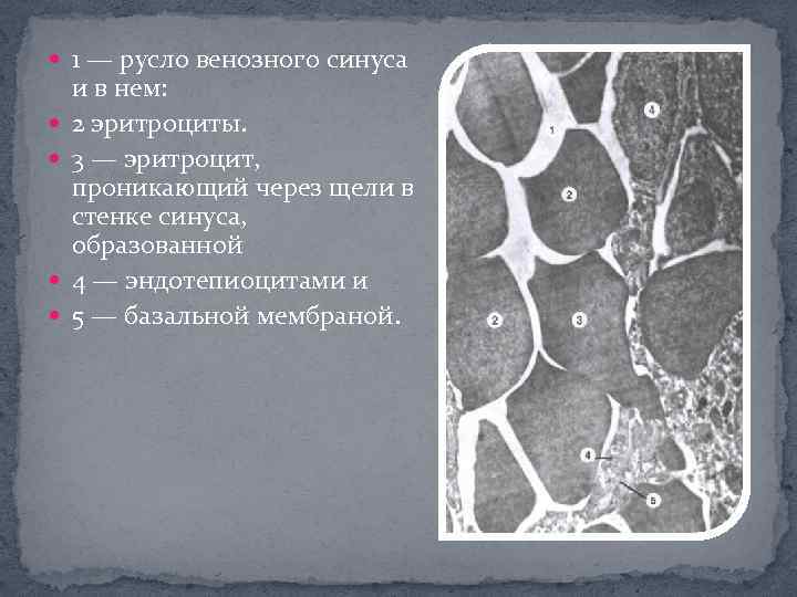  1 — русло венозного синуса и в нем: 2 эритроциты. 3 — эритроцит,