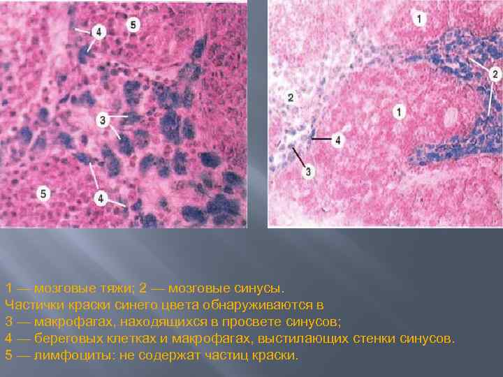 1 — мозговые тяжи; 2 — мозговые синусы. Частички краски синего цвета обнаруживаются в