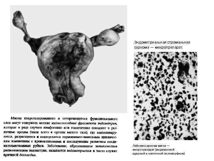 Эндометриальная стромальная саркома — макропрепарат. Лейомиосаркома матки — микропрепарат (выраженный ядерный и клеточный полиморфизм)