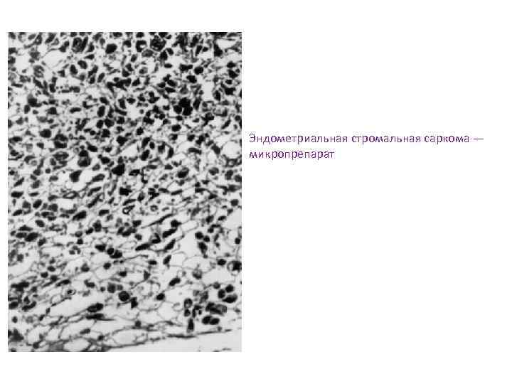Эндометриальная стромальная саркома — микропрепарат 