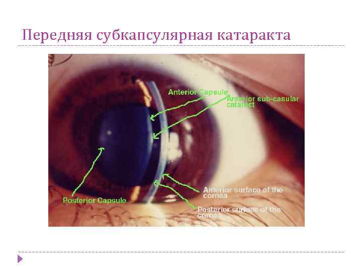 Передняя субкапсулярная катаракта 