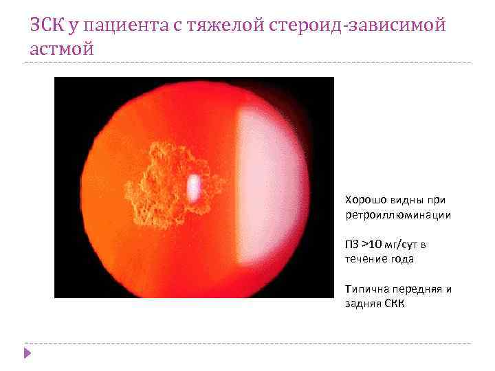 ЗСК у пациента с тяжелой стероид-зависимой астмой Хорошо видны при ретроиллюминации ПЗ >10 мг/сут