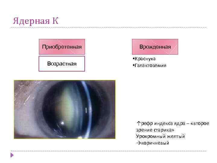 Ядерная К Приобретенная Возрастная Врожденная • Краснуха • Галактоземия ↑рефр индекса ядра – «второе