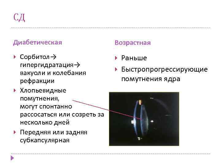 СД Диабетическая Сорбитол→ гипергидратация→ вакуоли и колебания рефракции Хлопьевидные помутнения, могут спонтанно рассосаться или